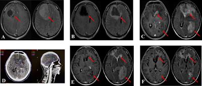 Bevacizumab combined with re-irradiation in recurrent glioblastoma